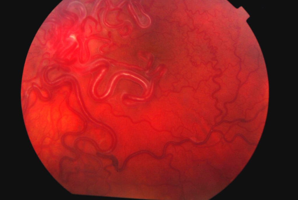 Left Eye - Not Normal