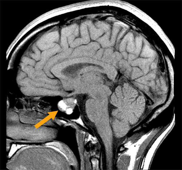 Unfortunately, the MRI scans of my tumour have been lost. But this gives you a pretty good idea. Image courtest of Mayfield Clinic