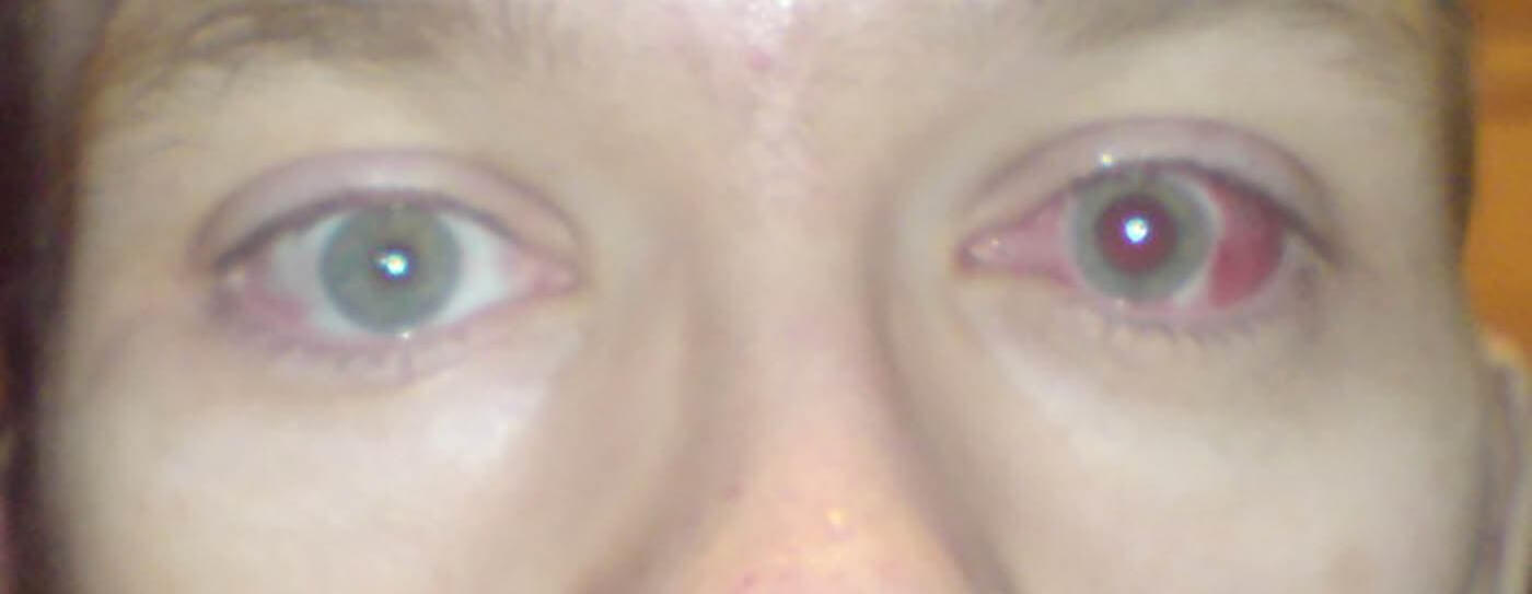 I doubt the surgeons call them ‘tumour scoops’. They're really called ‘curettes’. Image courtesy of www.marketlab.com