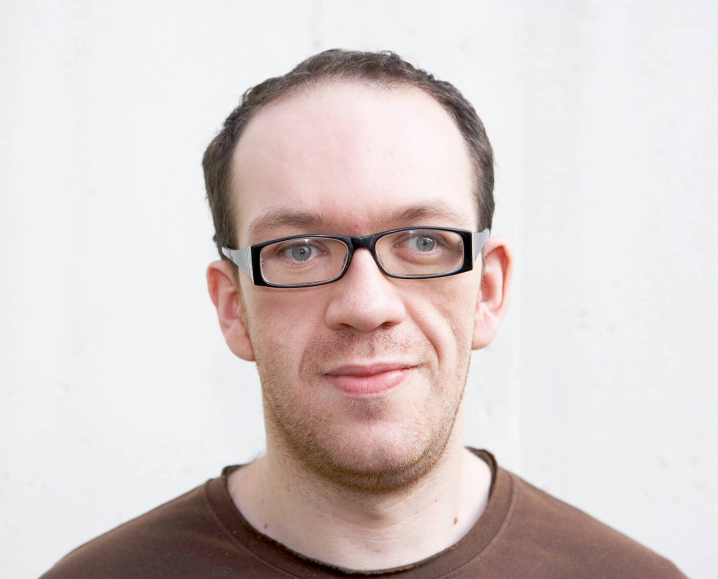 Pre-Surgery Acromegaly clearly visible. Pre-Eye surgery too.