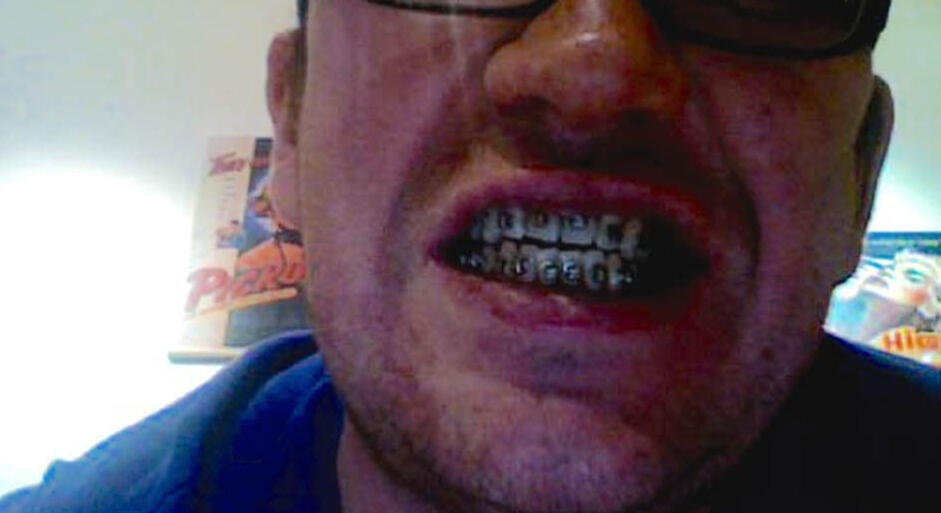 I doubt the surgeons call them ‘tumour scoops’. They&#39;re really called ‘curettes’. Image courtesy of www.marketlab.com